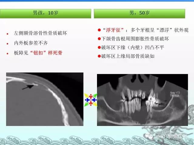 【PPT】骨嗜酸性肉芽肿的影像诊断