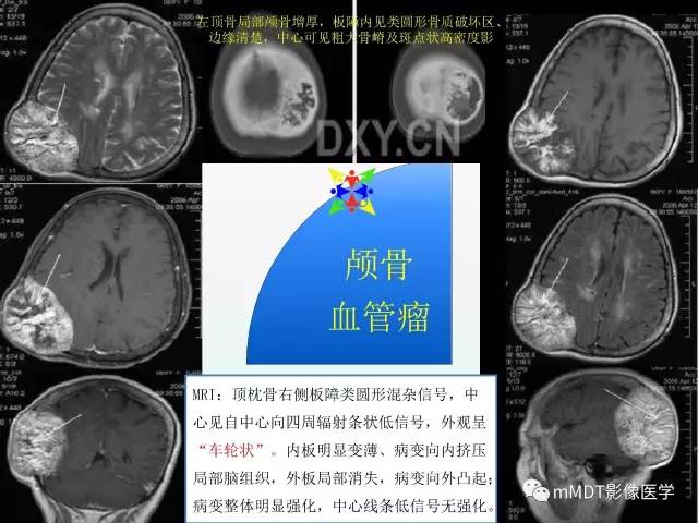 【PPT】骨嗜酸性肉芽肿的影像诊断