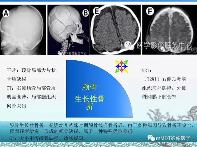 【PPT】骨嗜酸性肉芽肿的影像诊断