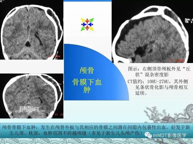 【PPT】骨嗜酸性肉芽肿的影像诊断