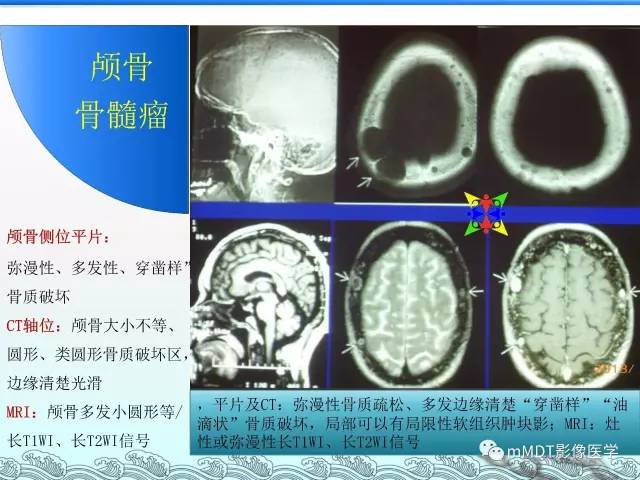 【PPT】骨嗜酸性肉芽肿的影像诊断