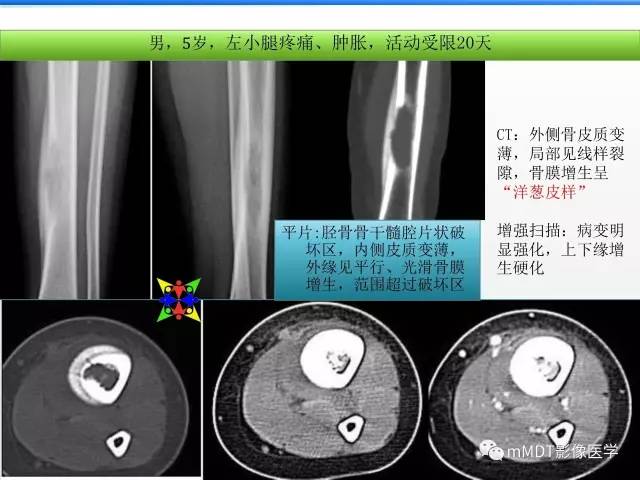【PPT】骨嗜酸性肉芽肿的影像诊断
