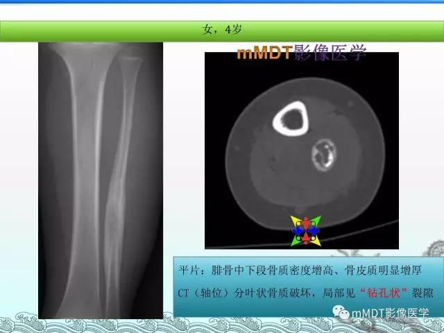 【PPT】骨嗜酸性肉芽肿的影像诊断
