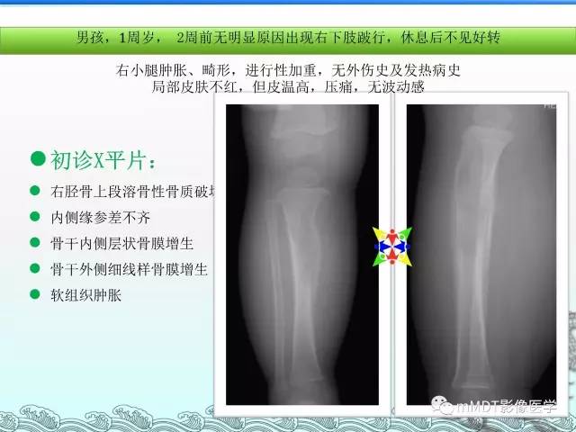 【PPT】骨嗜酸性肉芽肿的影像诊断