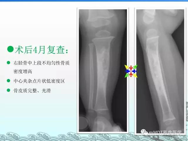 【PPT】骨嗜酸性肉芽肿的影像诊断