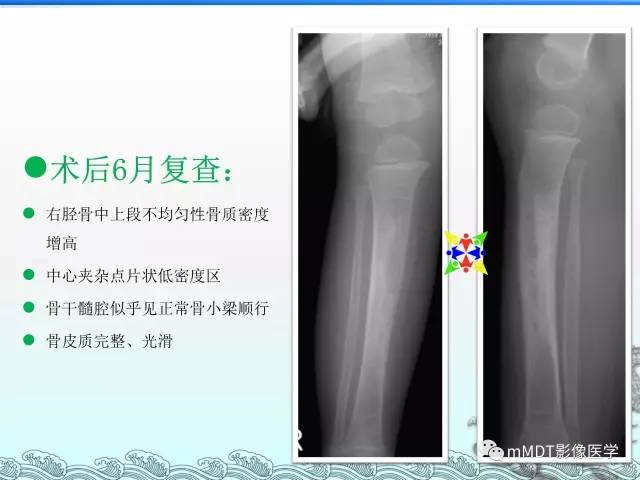 【PPT】骨嗜酸性肉芽肿的影像诊断