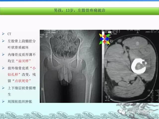 【PPT】骨嗜酸性肉芽肿的影像诊断