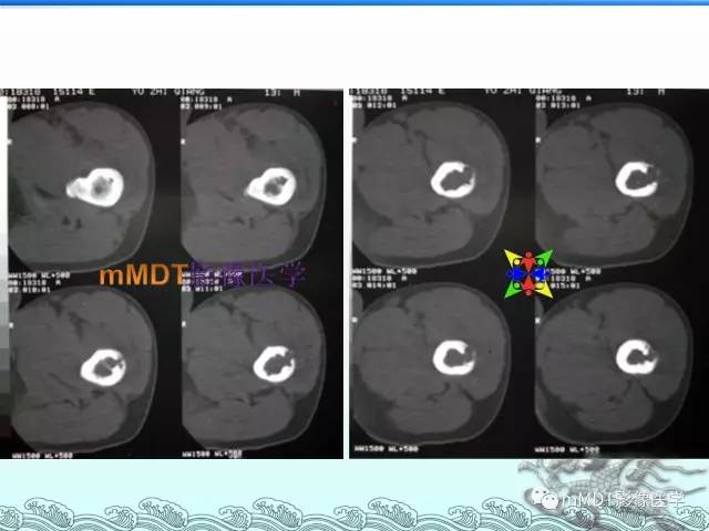 【PPT】骨嗜酸性肉芽肿的影像诊断