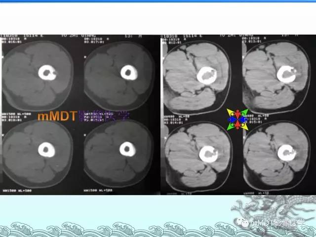 【PPT】骨嗜酸性肉芽肿的影像诊断