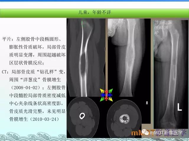 【PPT】骨嗜酸性肉芽肿的影像诊断