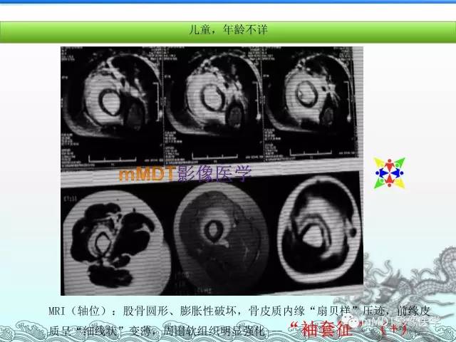 【PPT】骨嗜酸性肉芽肿的影像诊断