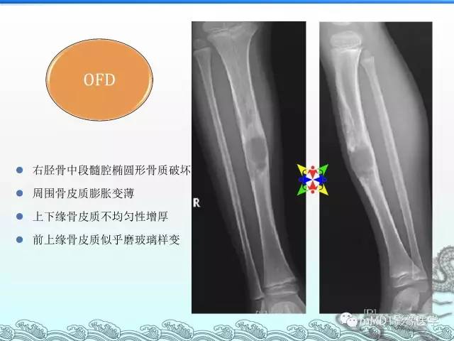 【PPT】骨嗜酸性肉芽肿的影像诊断