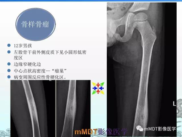 【PPT】骨嗜酸性肉芽肿的影像诊断