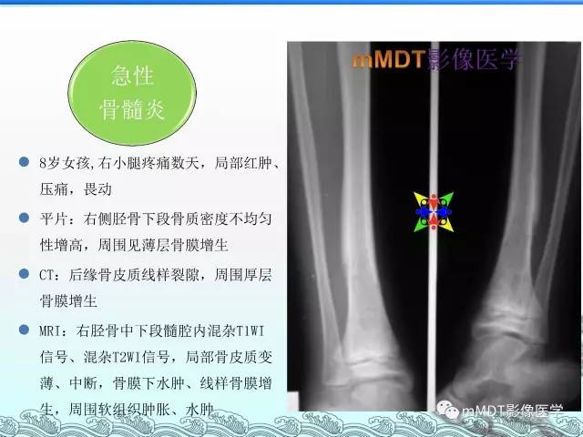 【PPT】骨嗜酸性肉芽肿的影像诊断