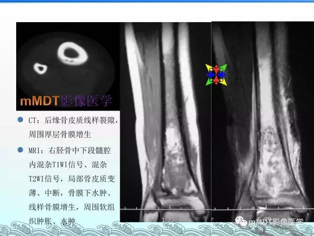 【PPT】骨嗜酸性肉芽肿的影像诊断