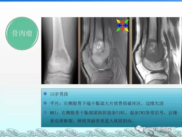 【PPT】骨嗜酸性肉芽肿的影像诊断