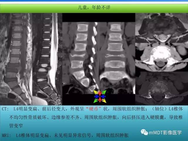【PPT】骨嗜酸性肉芽肿的影像诊断