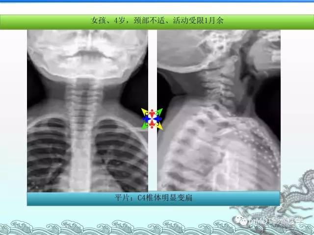 【PPT】骨嗜酸性肉芽肿的影像诊断