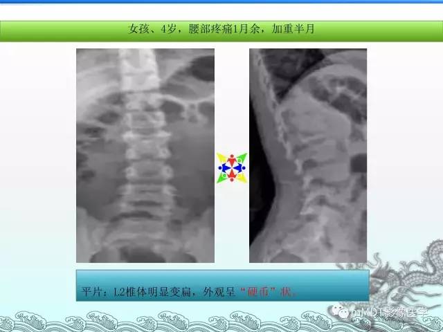 【PPT】骨嗜酸性肉芽肿的影像诊断