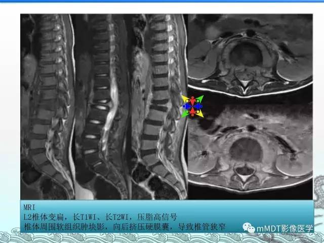 【PPT】骨嗜酸性肉芽肿的影像诊断