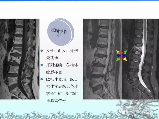 【PPT】骨嗜酸性肉芽肿的影像诊断