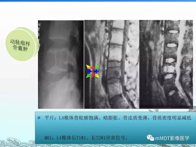 【PPT】骨嗜酸性肉芽肿的影像诊断