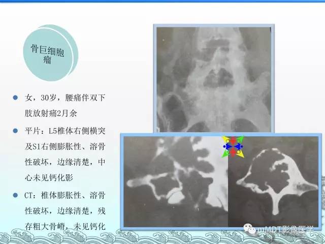 【PPT】骨嗜酸性肉芽肿的影像诊断