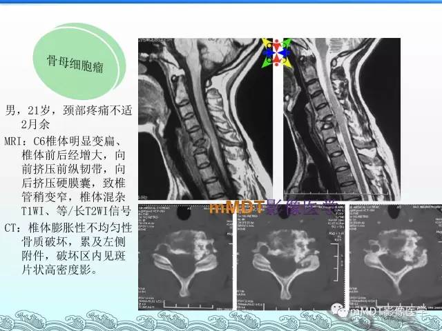 【PPT】骨嗜酸性肉芽肿的影像诊断
