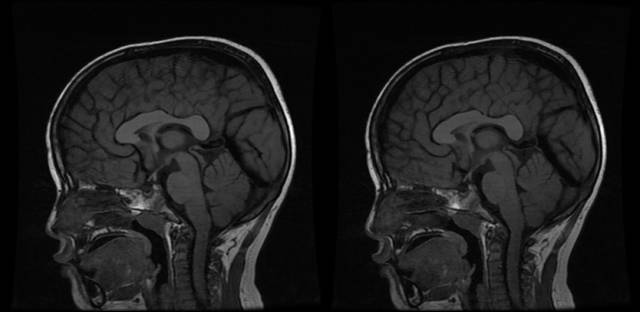 【病例】垂体柄阻断综合征1例MR影像表现 【病例】垂体柄阻断综合征1例MR影像表现