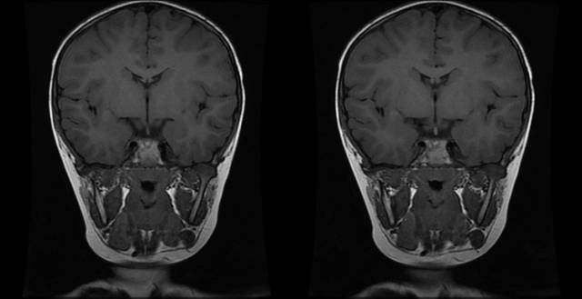 【病例】垂体柄阻断综合征1例MR影像表现 【病例】垂体柄阻断综合征1例MR影像表现