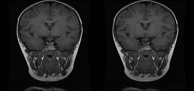 【病例】垂体柄阻断综合征1例MR影像表现 【病例】垂体柄阻断综合征1例MR影像表现