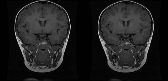 【病例】垂体柄阻断综合征1例MR影像表现 【病例】垂体柄阻断综合征1例MR影像表现
