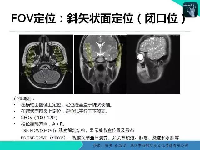 【PPT】颞下颌关节紊乱的MRI诊断
