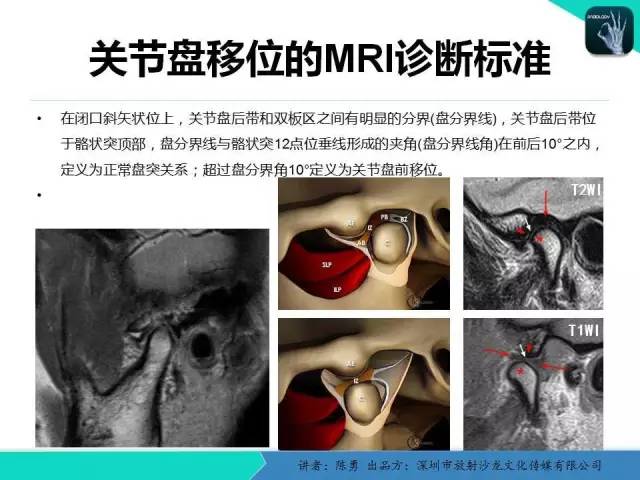 【PPT】颞下颌关节紊乱的MRI诊断