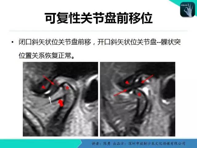 【PPT】颞下颌关节紊乱的MRI诊断