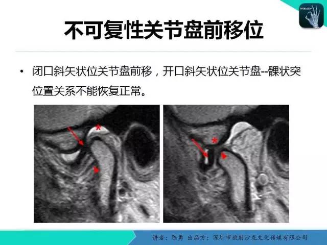 【PPT】颞下颌关节紊乱的MRI诊断