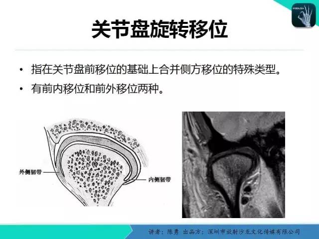 【PPT】颞下颌关节紊乱的MRI诊断