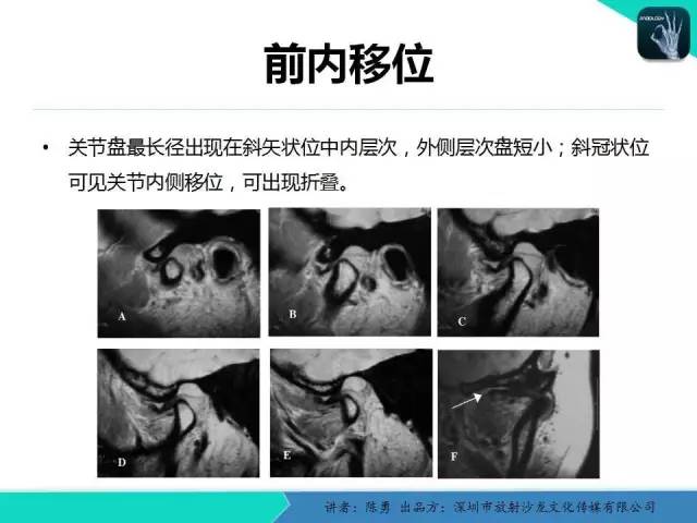 【PPT】颞下颌关节紊乱的MRI诊断