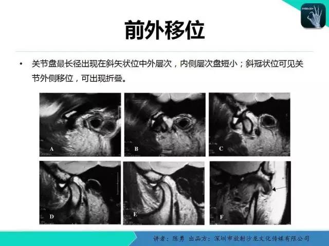【PPT】颞下颌关节紊乱的MRI诊断