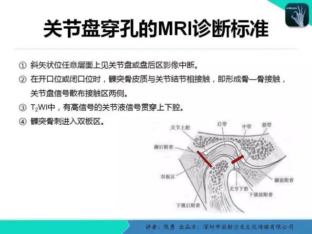 【PPT】颞下颌关节紊乱的MRI诊断