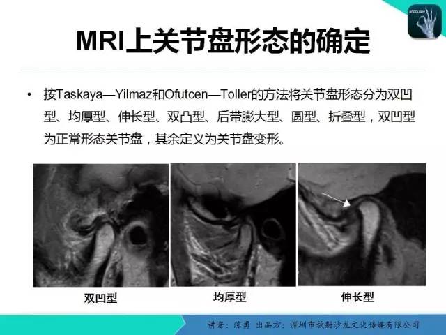 【PPT】颞下颌关节紊乱的MRI诊断