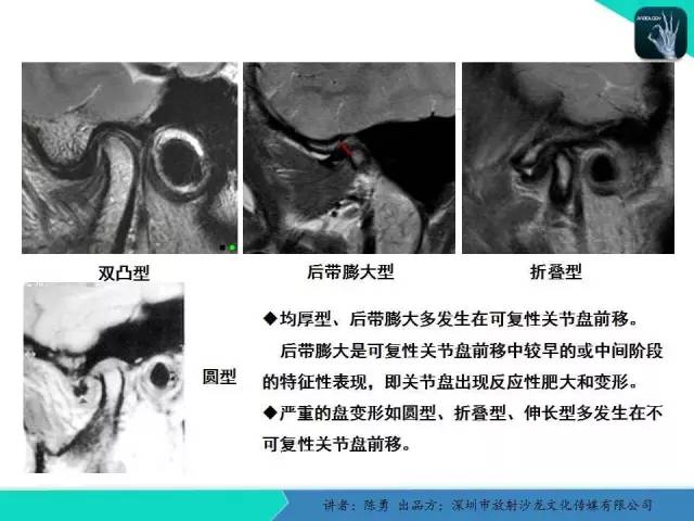 【PPT】颞下颌关节紊乱的MRI诊断