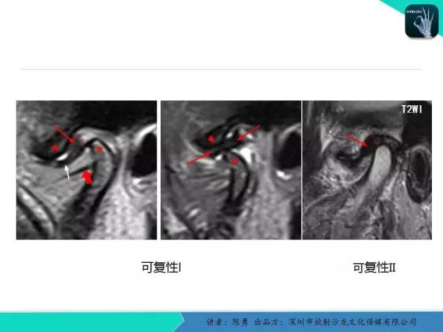 【PPT】颞下颌关节紊乱的MRI诊断
