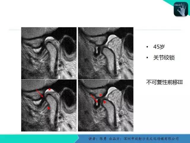 【PPT】颞下颌关节紊乱的MRI诊断
