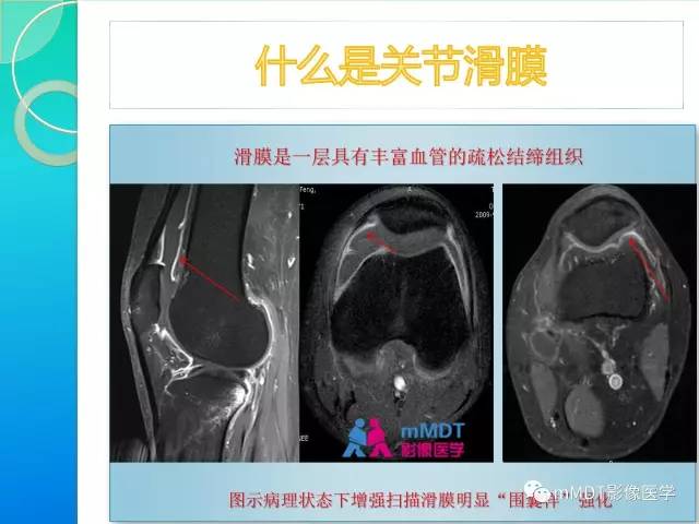 【PPT】7种累及关节滑膜的病变你GET了吗