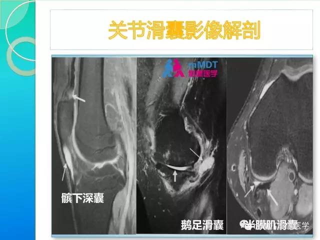 【PPT】7种累及关节滑膜的病变你GET了吗
