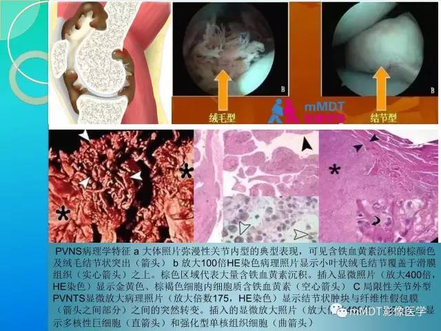 【PPT】7种累及关节滑膜的病变你GET了吗