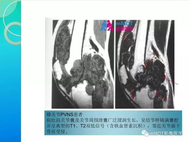 【PPT】7种累及关节滑膜的病变你GET了吗