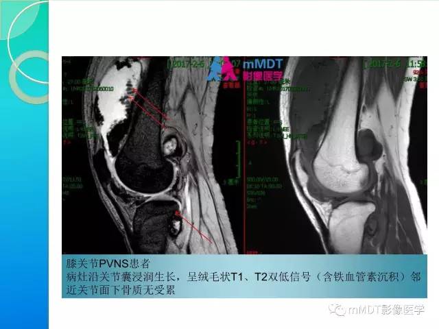 【PPT】7种累及关节滑膜的病变你GET了吗