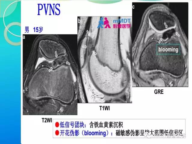 【PPT】7种累及关节滑膜的病变你GET了吗